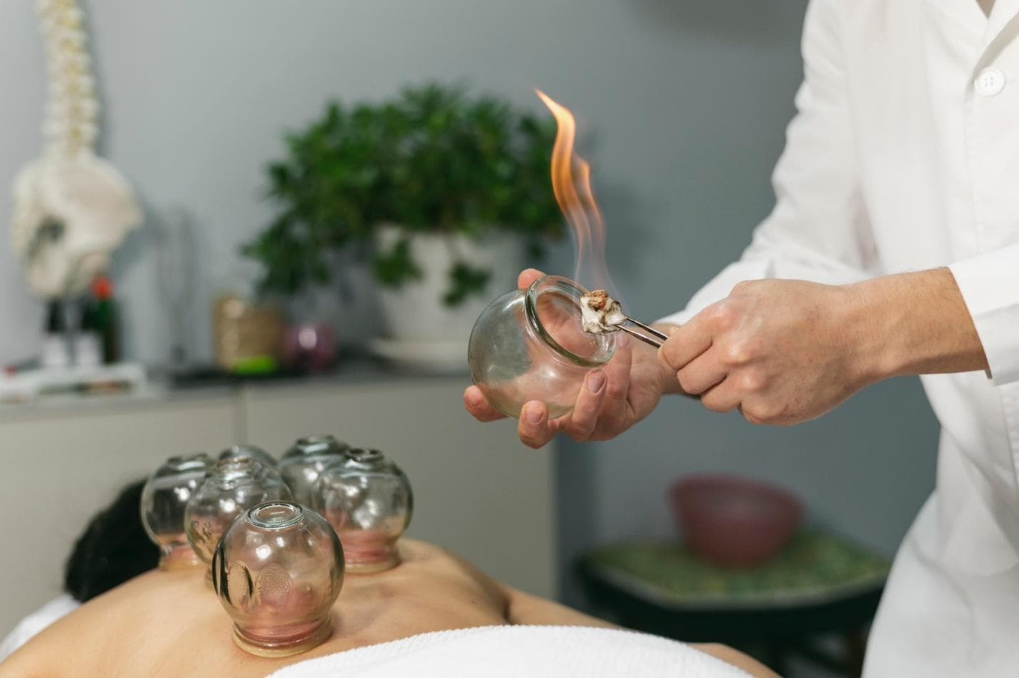 Fire Cupping Therapy