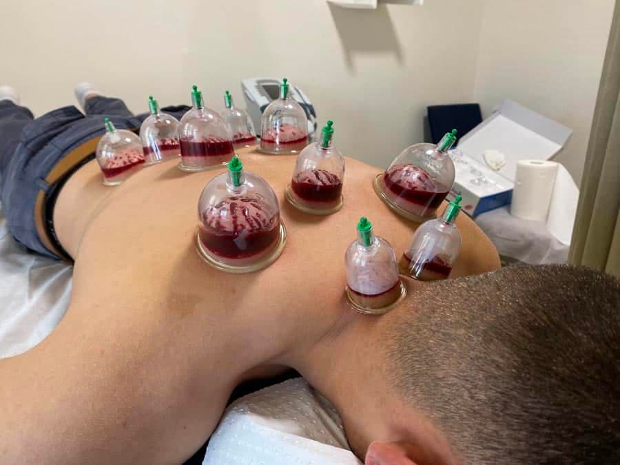Wet Cupping / Hijama Therapy